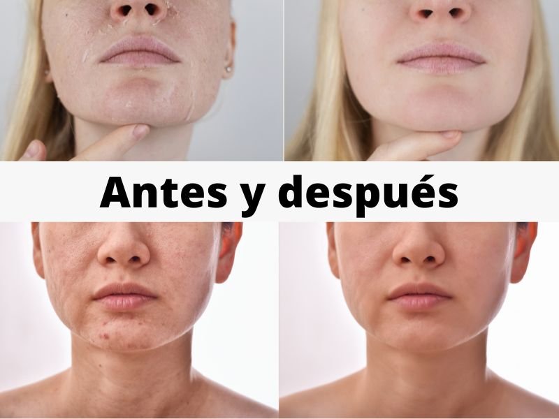 Hifu facial antes y después