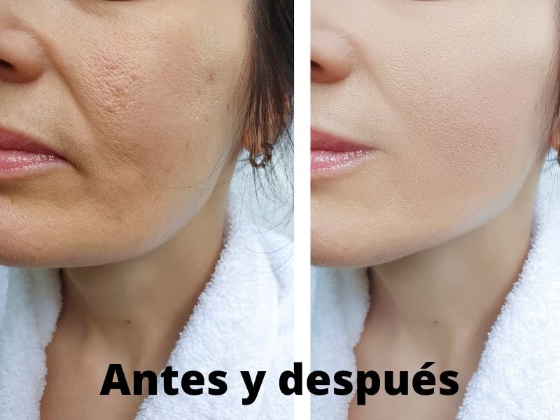 Tratamiento con hifu