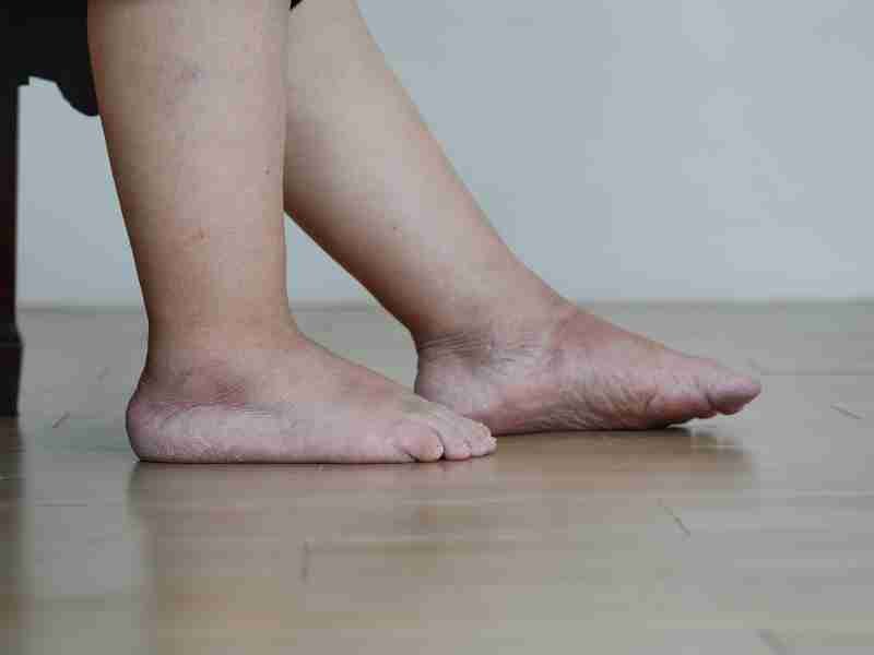Fisioterapia - Tratamiento lipedema - Imagen 2