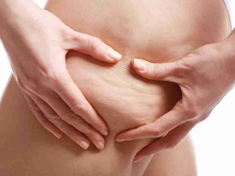 Fisioterapia - Tratamiento lipedema - Imagen 4